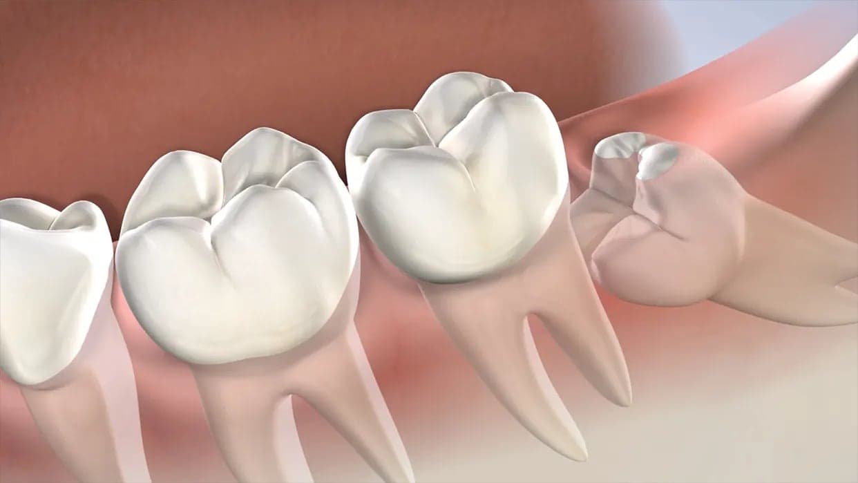 Wisdom Tooth Extraction